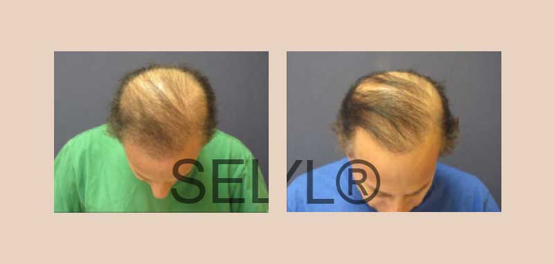 PRFM Hair Treatment Before & After Photos midtown manhattan